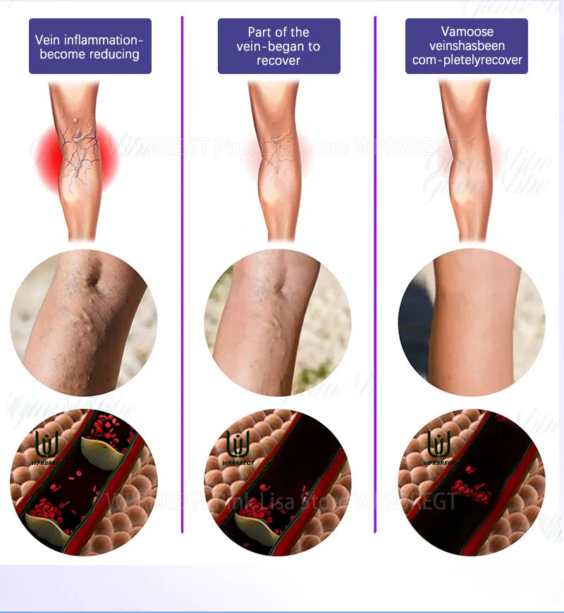 Restore normal tendons and veins, no pain