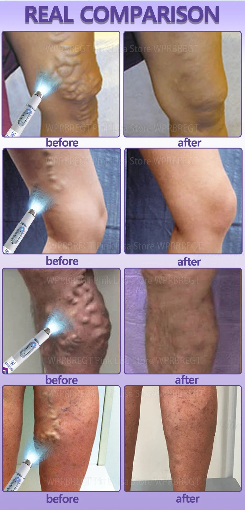 Restore normal tendons and veins, no pain
